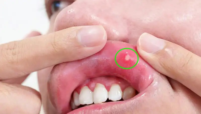 Kanserin Sessiz Uyarısı: Dili Alınmak Zorunda Kalan Bir Yaşam